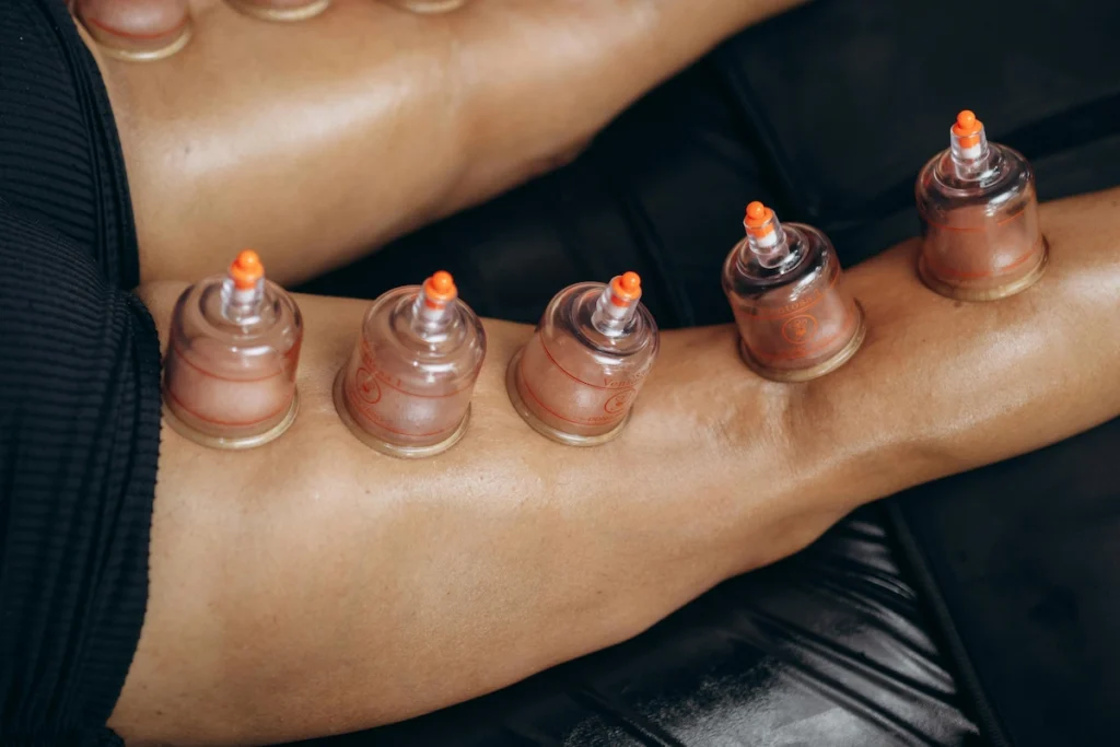 Student-athlete receiving cupping therapy at the athletic training center